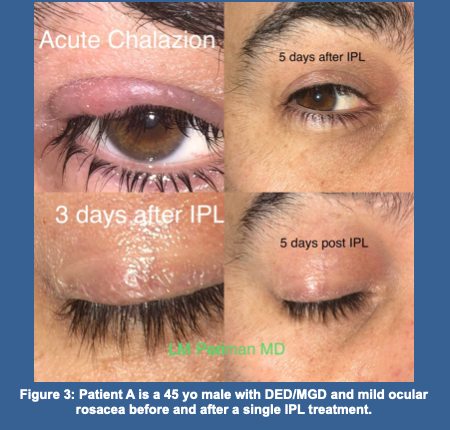 Novel, Non-Invasive Method for Addressing Acute and Chronic Chalazia: a case series- Dr. Laura Periman