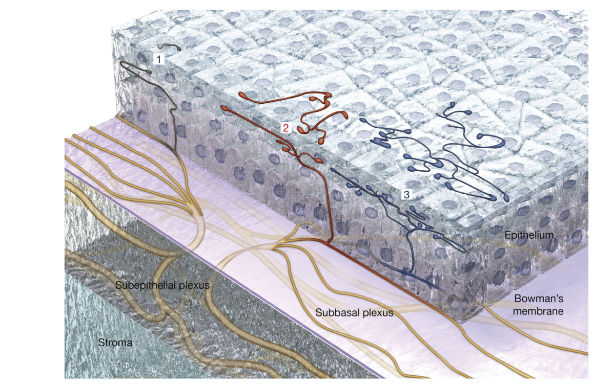 Confocal microscopy of a neuropathic cornea