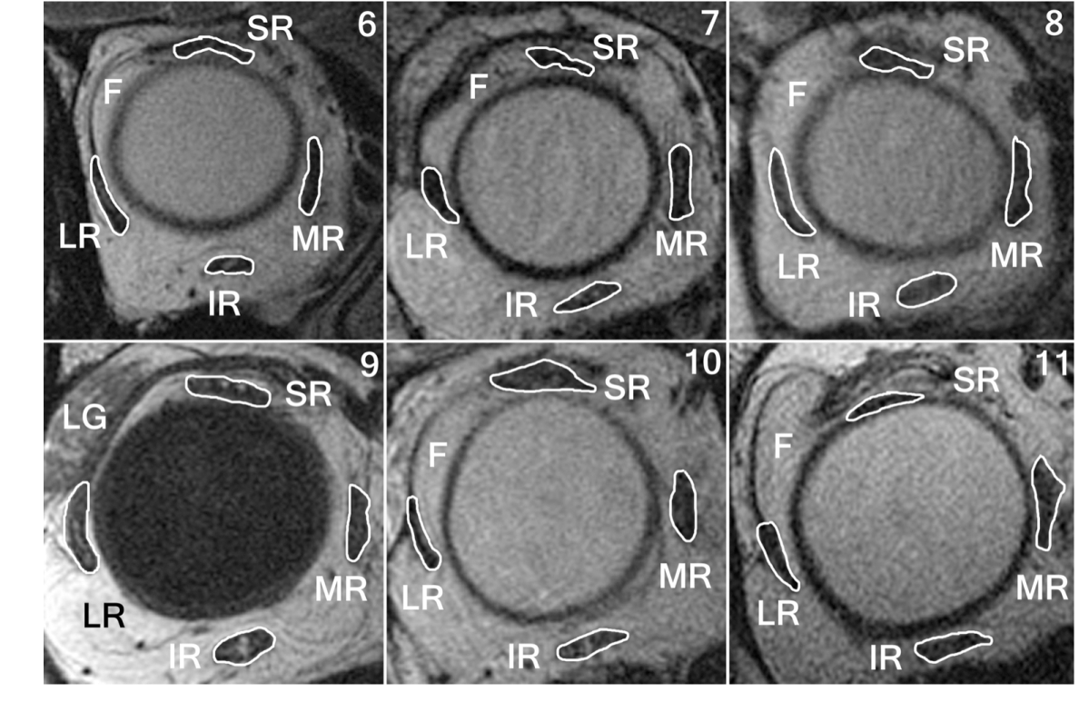 Heavy eye syndrome versus sagging eye syndrome in high myopia