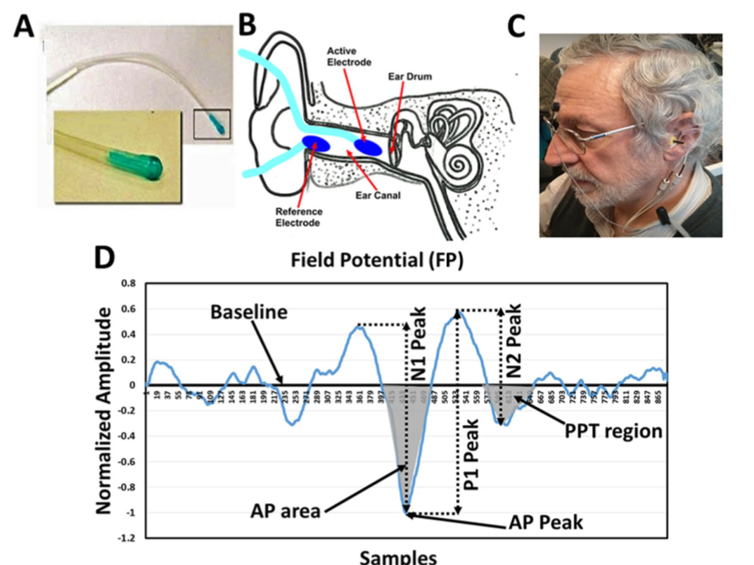 Electrovestibulography (EVestG) for Post-concussion syndrome (PCS)