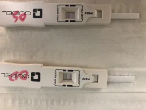 Mmp-9 positive : Chalazion