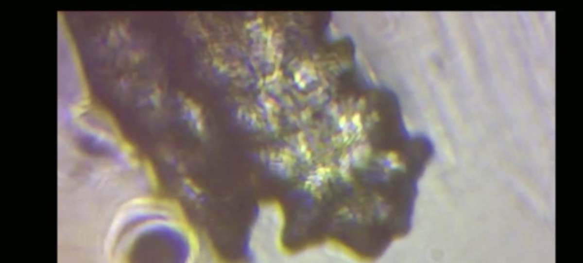 Palpebral and facial skin infestation by Demodex folliculorum – Contact Lens and Anterior Eye